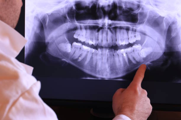 Best Emergency Root Canal Treatment in Onalaska, TX