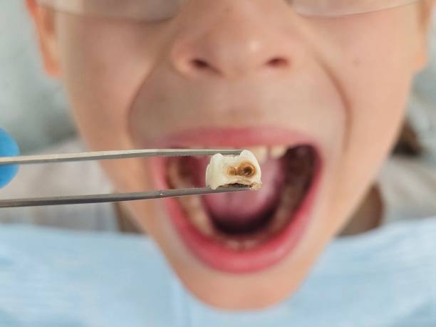 Best Emergency Root Canal Treatment in Onalaska, TX