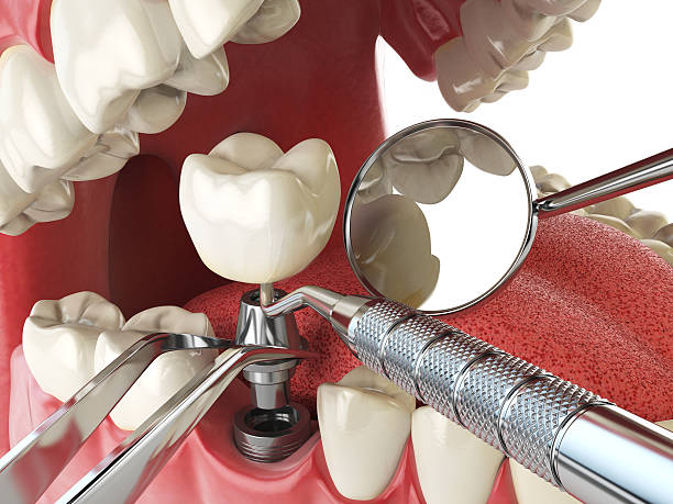 Best Emergency Treatment for Toothache in Onalaska, TX